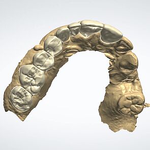 Intraoralscan CAD-Design