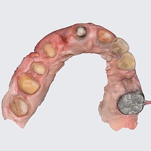 Intraoralscan Dental